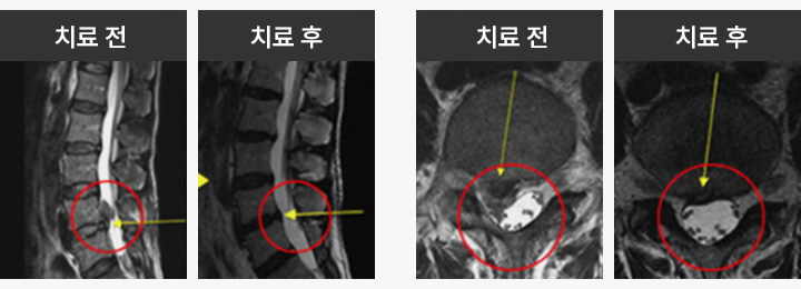 대전한방병원의 도침요법을 받은 요추 추간판 탈출증 환자의 치료 전후 MRI 사진 비교 결과 도표